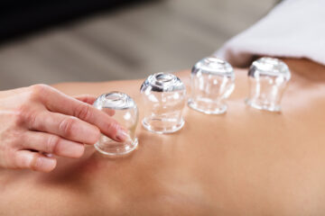 Cupping Physical Therapy In Royal Oak