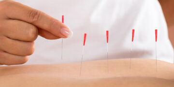Top Benefits of Acupuncture in Treating Immune Deficiency